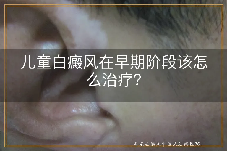 儿童白癜风在早期阶段该怎么治疗？