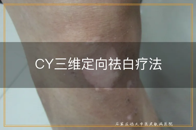 CY三维定向祛白疗法