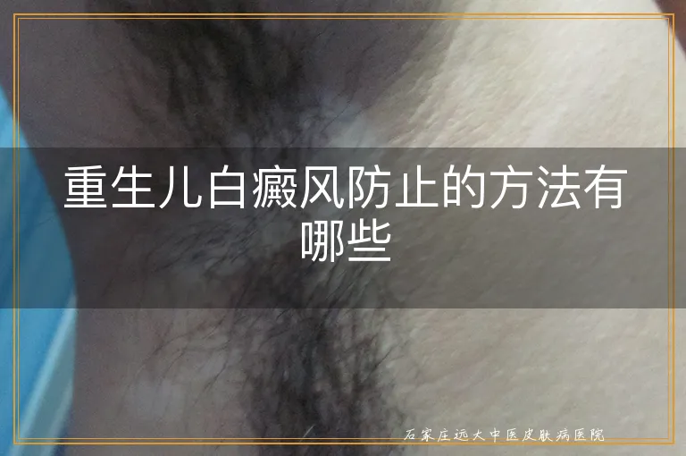 重生儿白癜风防止的方法有哪些