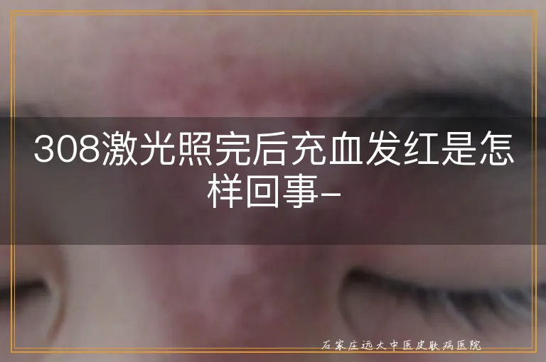 308激光照完后充血发红是怎样回事-