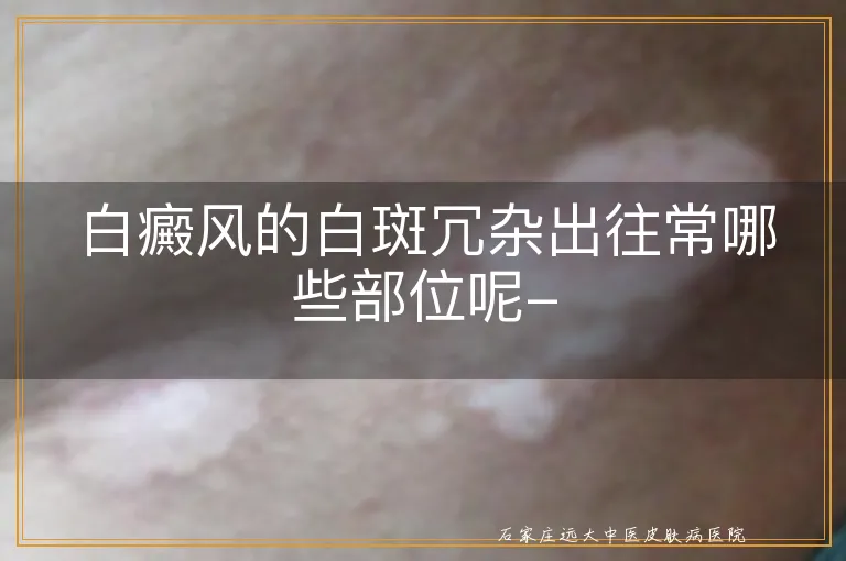 白癜风的白斑冗杂出往常哪些部位呢-