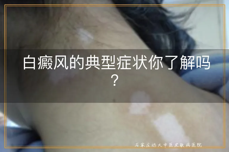 白癜风的典型症状你了解吗？