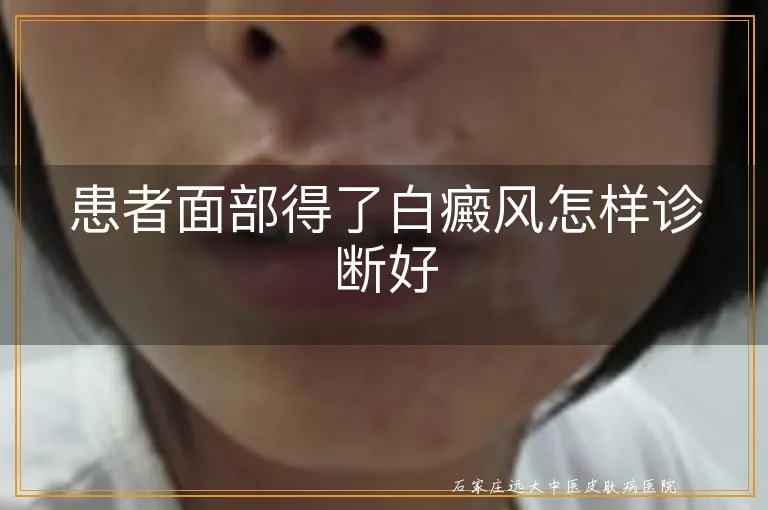 患者面部得了白癜风怎样诊断好