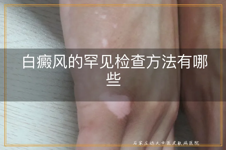 白癜风的罕见检查方法有哪些