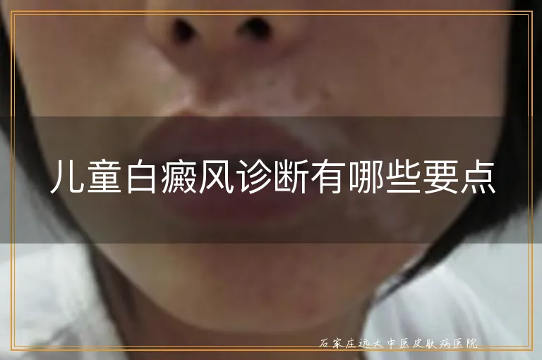 儿童白癜风诊断有哪些要点