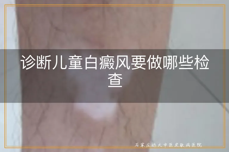 诊断儿童白癜风要做哪些检查