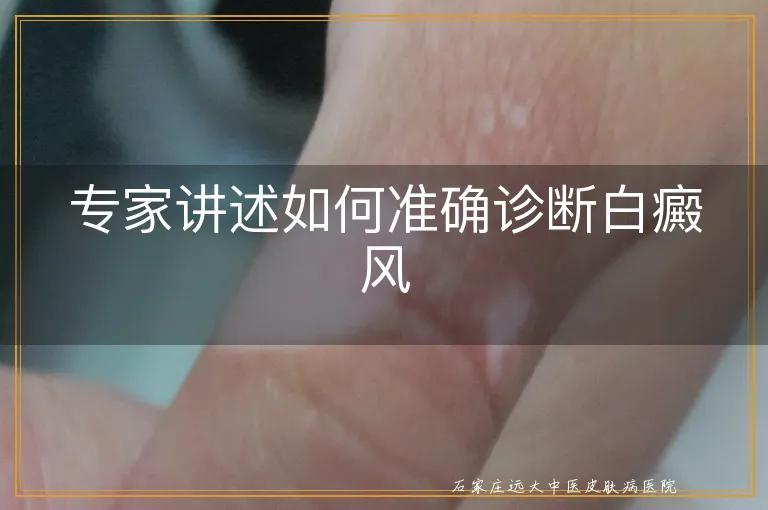 专家讲述如何准确诊断白癜风