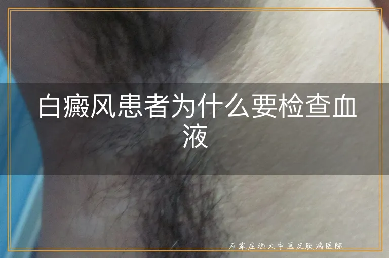 白癜风患者为什么要检查血液