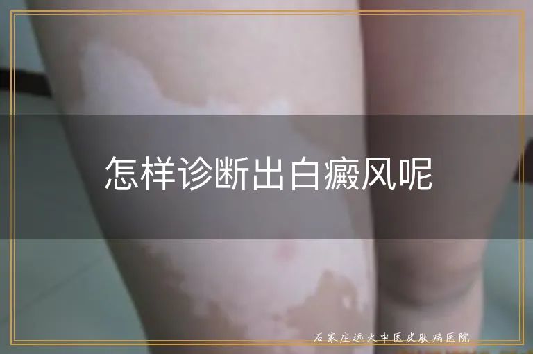 怎样诊断出白癜风呢