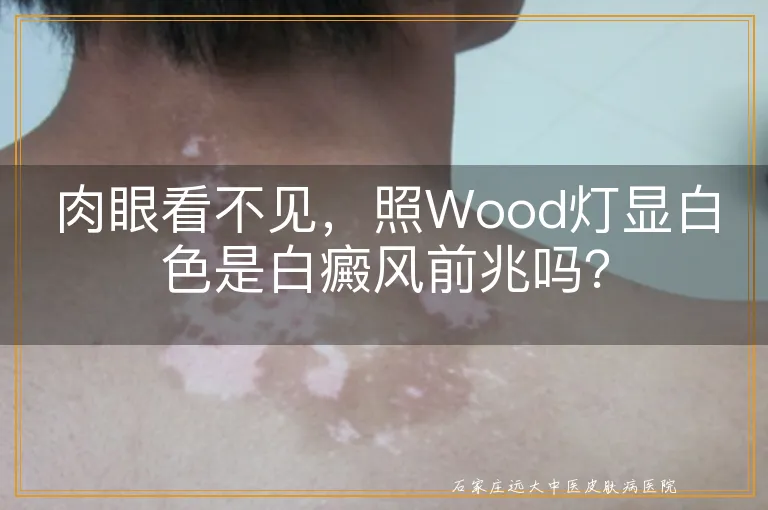 肉眼看不见，照Wood灯显白色是白癜风前兆吗？