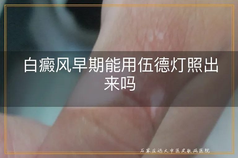 白癜风早期能用伍德灯照出来吗