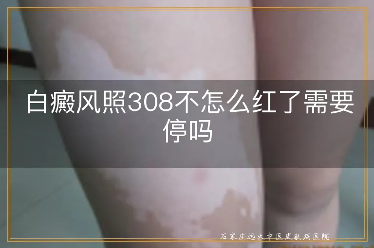 白癜风照308不怎么红了需要停吗