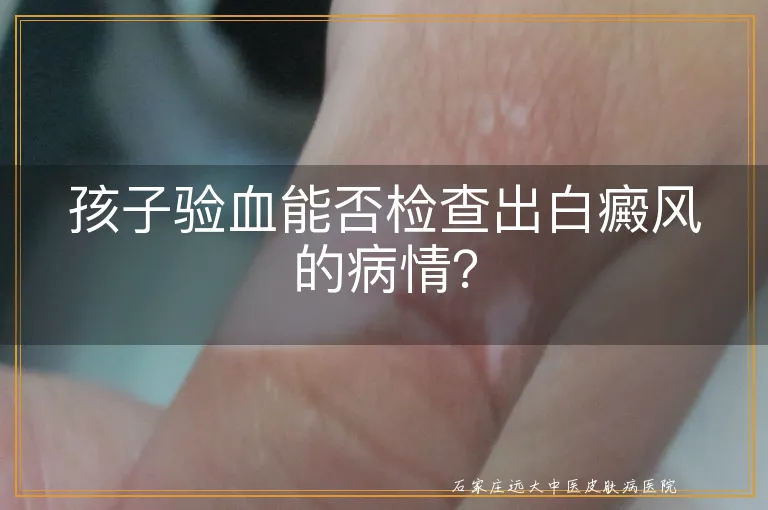 孩子验血能否检查出白癜风的病情？