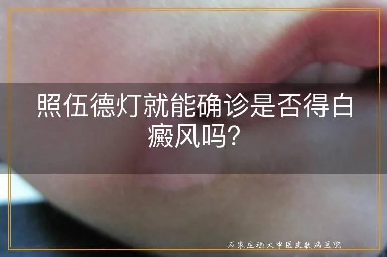 照伍德灯就能确诊是否得白癜风吗？