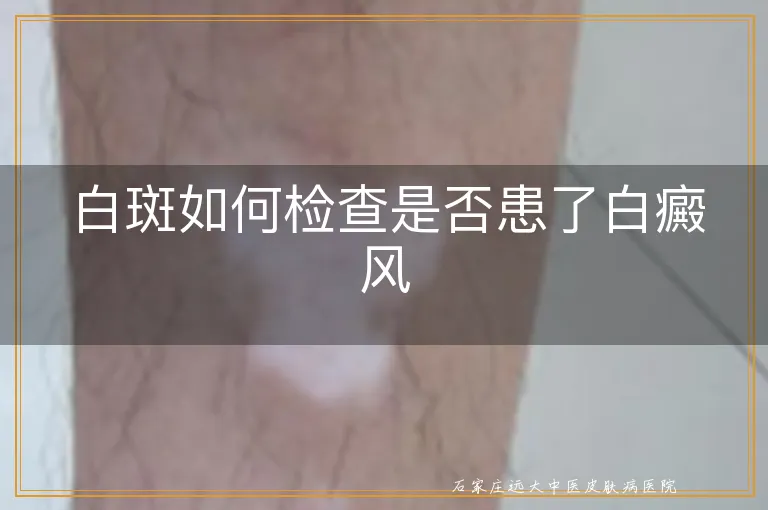 白斑如何检查是否患了白癜风