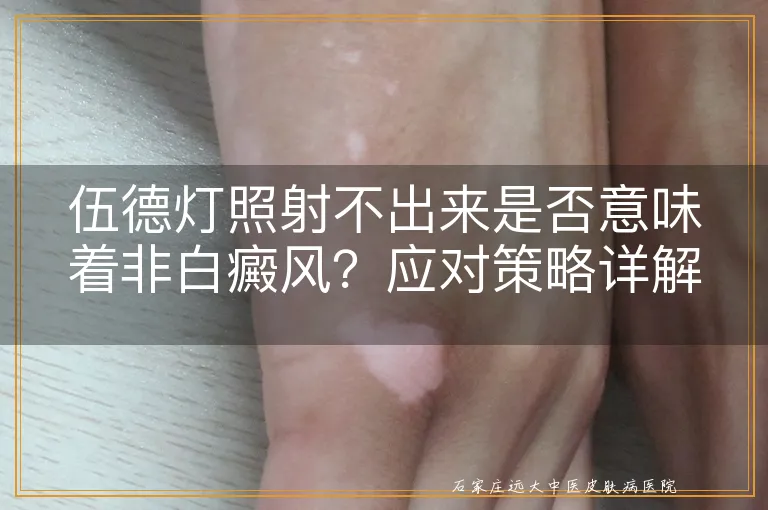 伍德灯照射不出来是否意味着非白癜风？应对策略详解