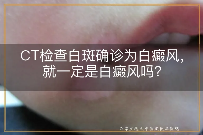 CT检查白斑确诊为白癜风，就一定是白癜风吗？