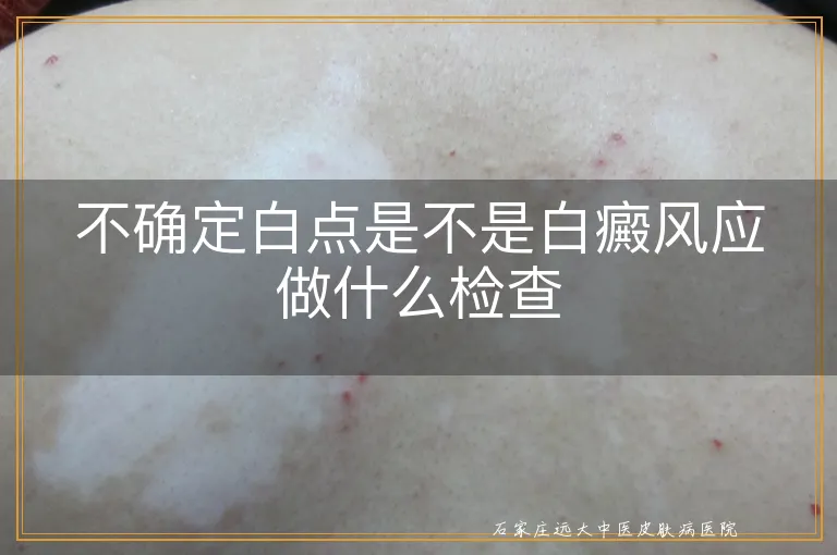 不确定白点是不是白癜风应做什么检查