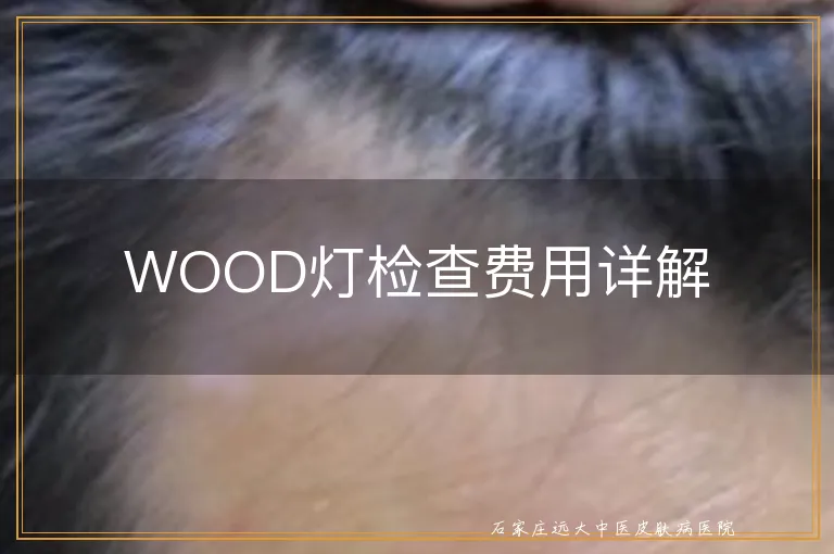 WOOD灯检查费用详解