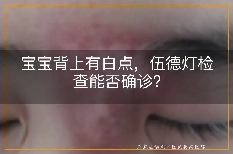 宝宝背上有白点，伍德灯检查能否确诊？