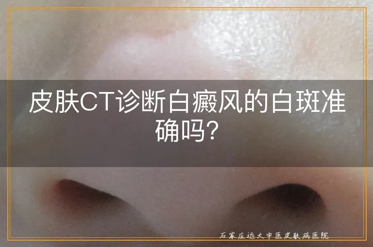 皮肤CT诊断白癜风的白斑准确吗？