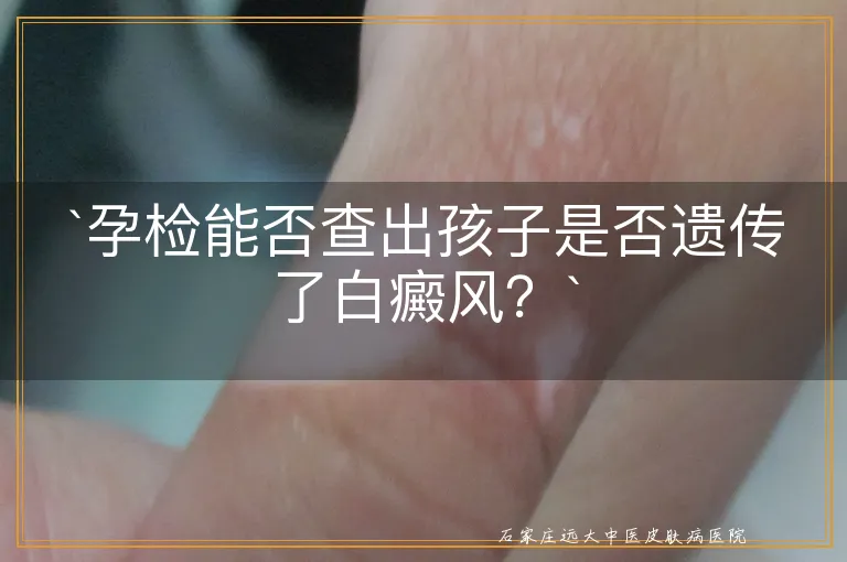 孕检能否查出孩子是否遗传了白癜风？