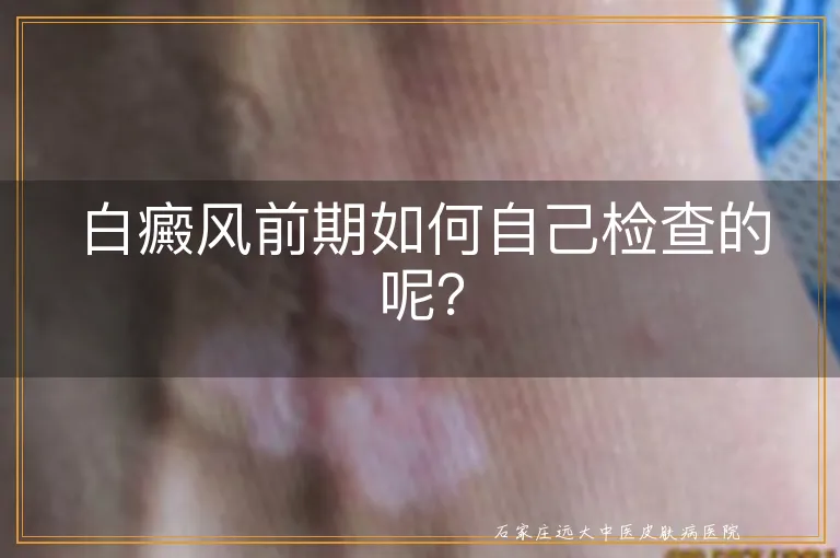 白癜风前期如何自己检查的呢？