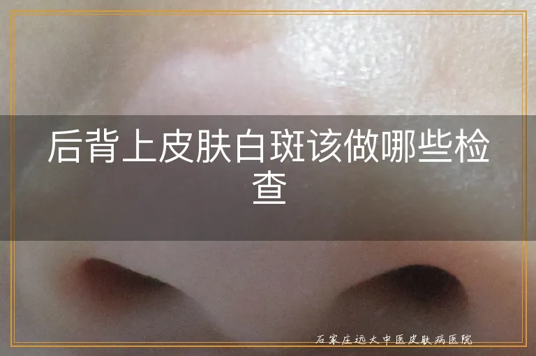 后背上皮肤白斑该做哪些检查