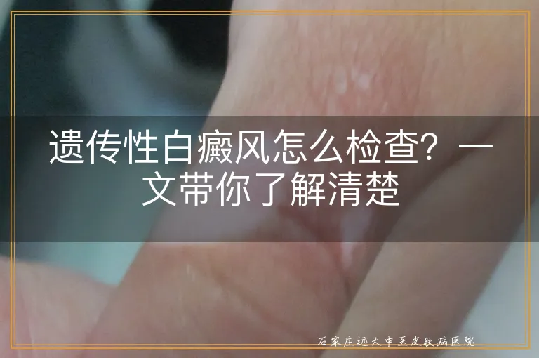 遗传性白癜风怎么检查？一文带你了解清楚