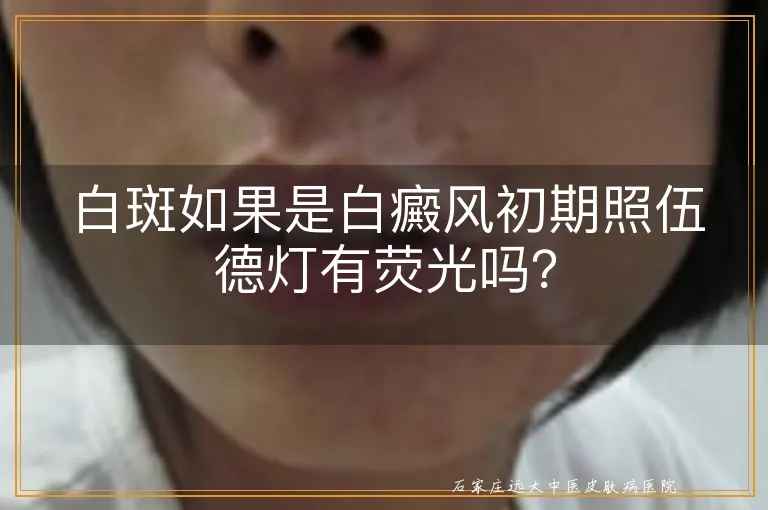 白斑如果是白癜风初期照伍德灯有荧光吗？