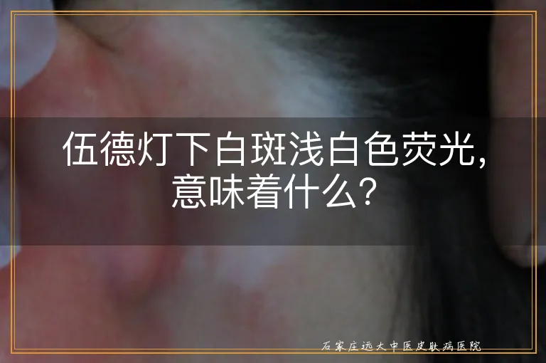 伍德灯下白斑浅白色荧光，意味着什么？