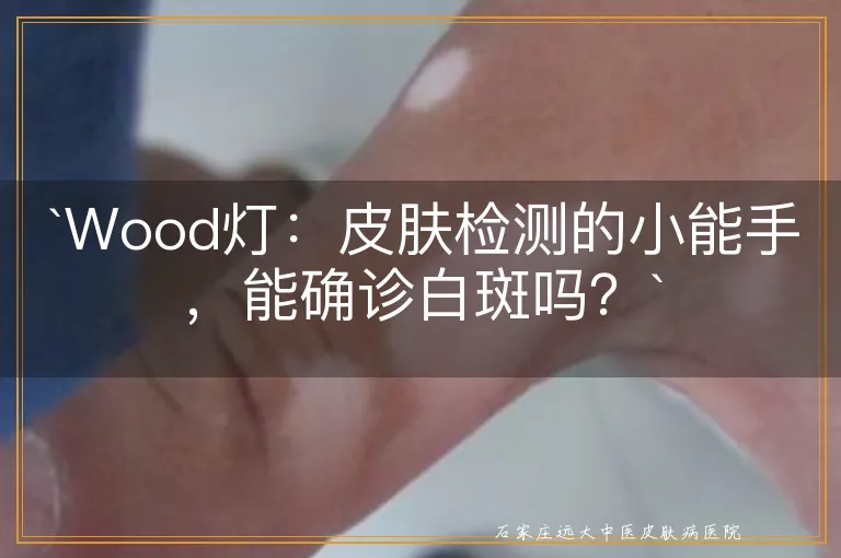 `Wood灯：皮肤检测的小能手，能确诊白斑吗？`