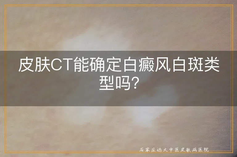 皮肤CT能确定白癜风白斑类型吗？