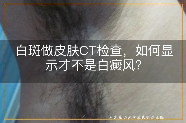 白斑做皮肤CT检查，如何显示才不是白癜风？