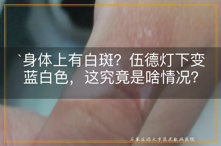 `身体上有白斑？伍德灯下变蓝白色，这究竟是啥情况？`