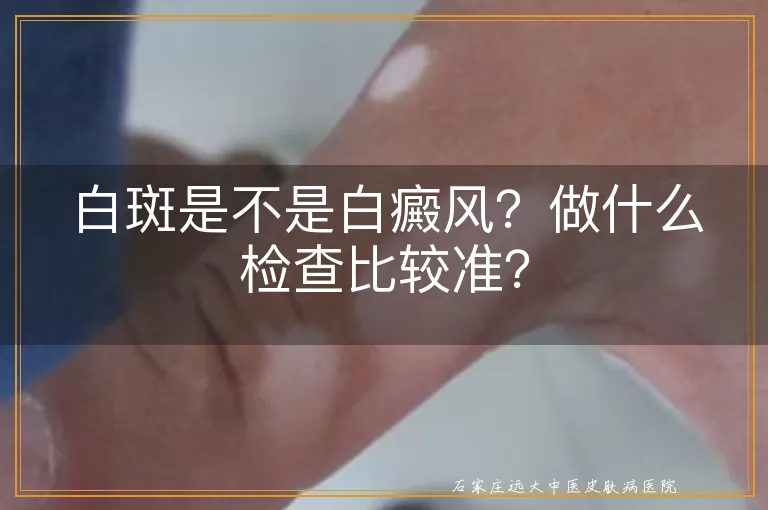 白斑是不是白癜风？做什么检查比较准？