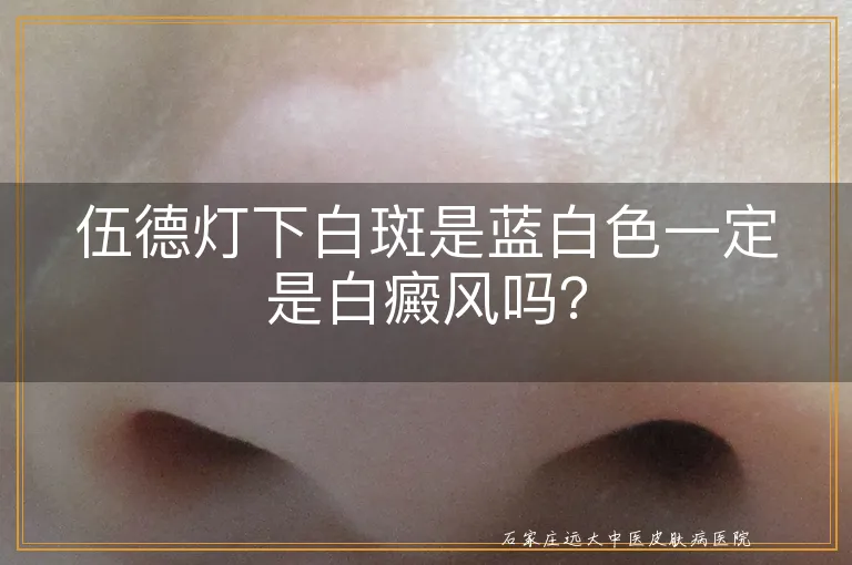 伍德灯下白斑是蓝白色一定是白癜风吗？