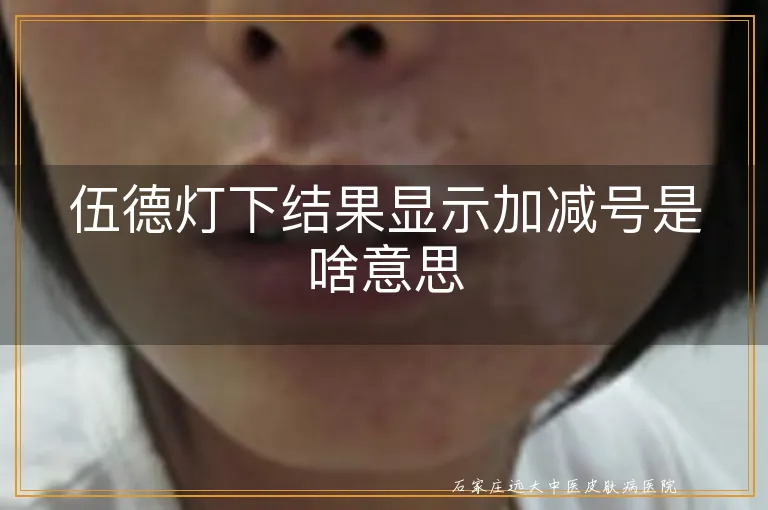 伍德灯下结果显示加减号是啥意思