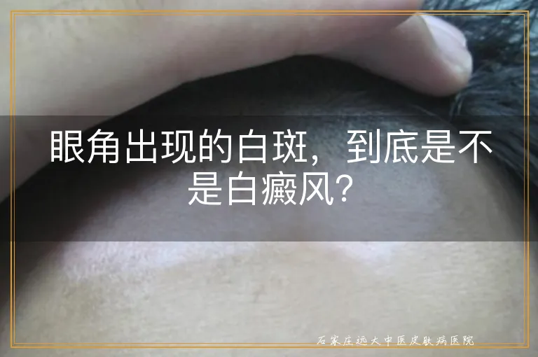 眼角出现的白斑，到底是不是白癜风？