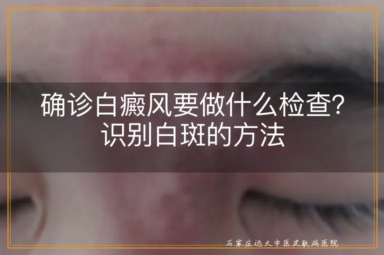 确诊白癜风要做什么检查？识别白斑的方法