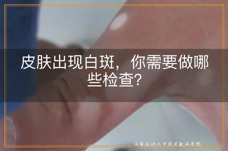 皮肤出现白斑，你需要做哪些检查？