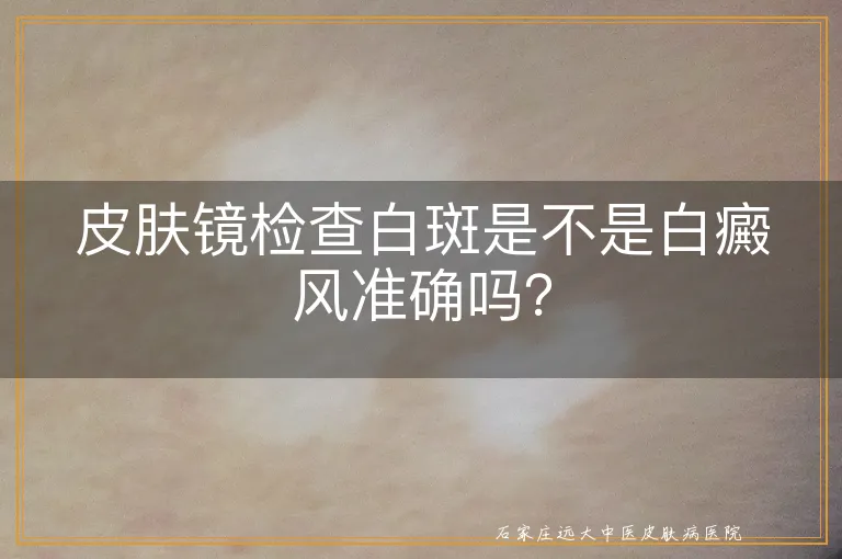 皮肤镜检查白斑是不是白癜风准确吗？