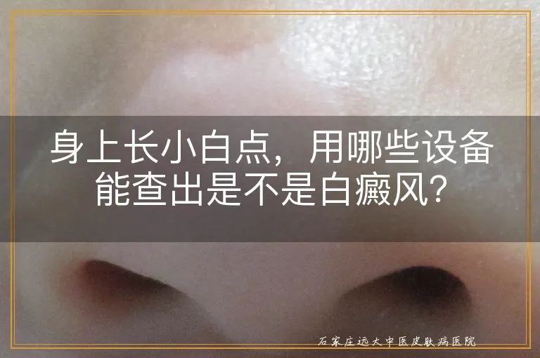 身上长小白点，用哪些设备能查出是不是白癜风？