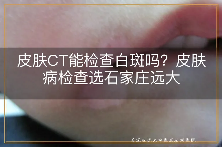 皮肤CT能检查白斑吗？皮肤病检查选石家庄远大