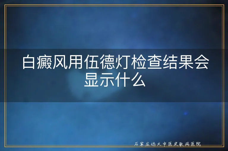 白癜风用伍德灯检查结果会显示什么