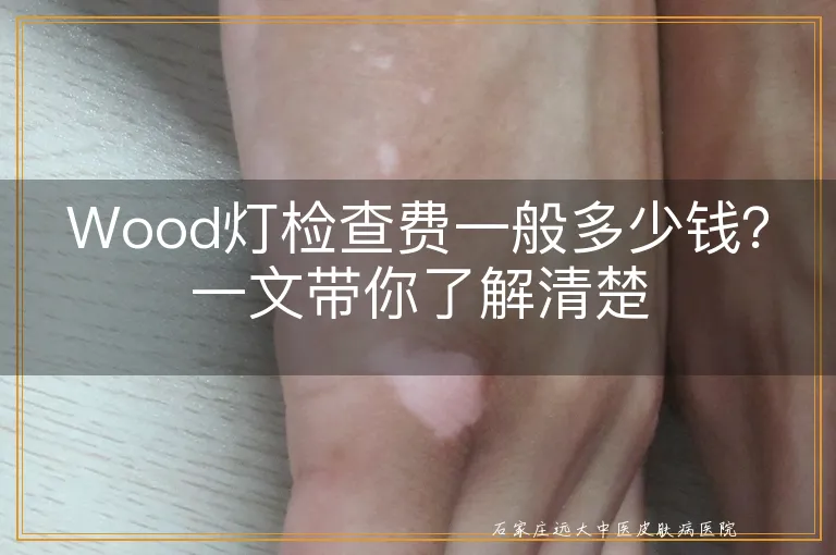 Wood灯检查费一般多少钱？一文带你了解清楚