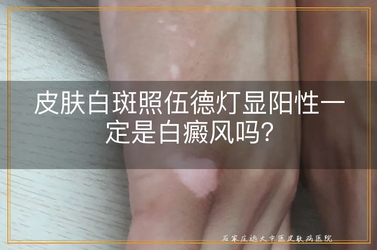 皮肤白斑照伍德灯显阳性一定是白癜风吗？