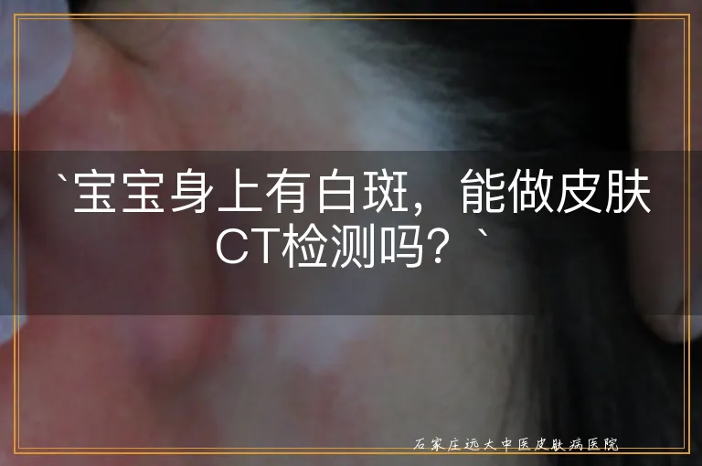 `宝宝身上有白斑，能做皮肤CT检测吗？`