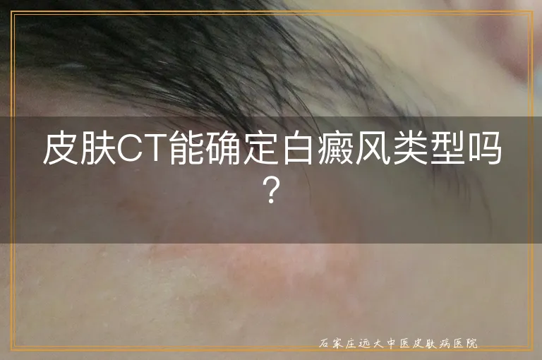 皮肤CT能确定白癜风类型吗？