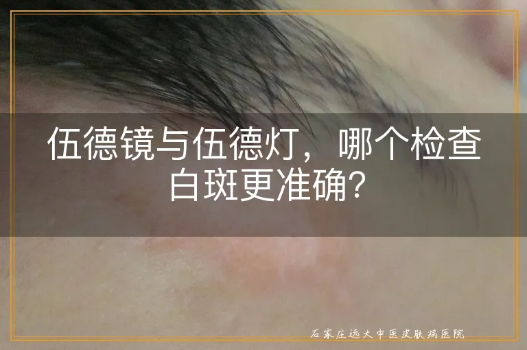 伍德镜与伍德灯，哪个检查白斑更准确？